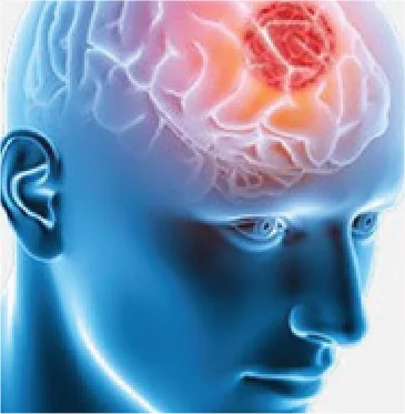Brain Tumor: An Overview